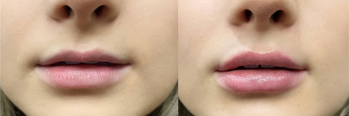 Lip Augmentation Before & After Gallery - Patient 550414 - Image 1