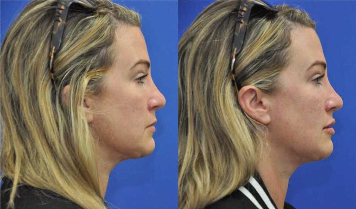 Lip Augmentation Before & After Gallery - Patient 245609 - Image 3