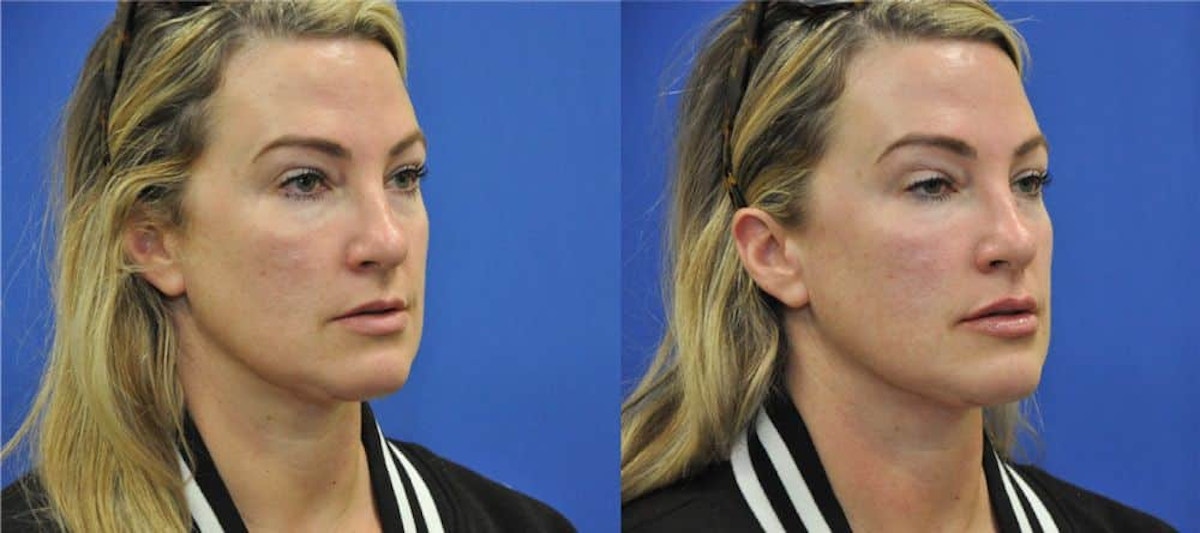 Lip Augmentation Before & After Gallery - Patient 245609 - Image 1