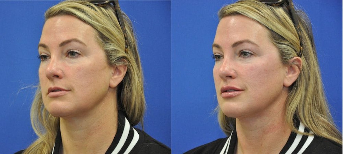 Lip Augmentation Before & After Gallery - Patient 245609 - Image 2