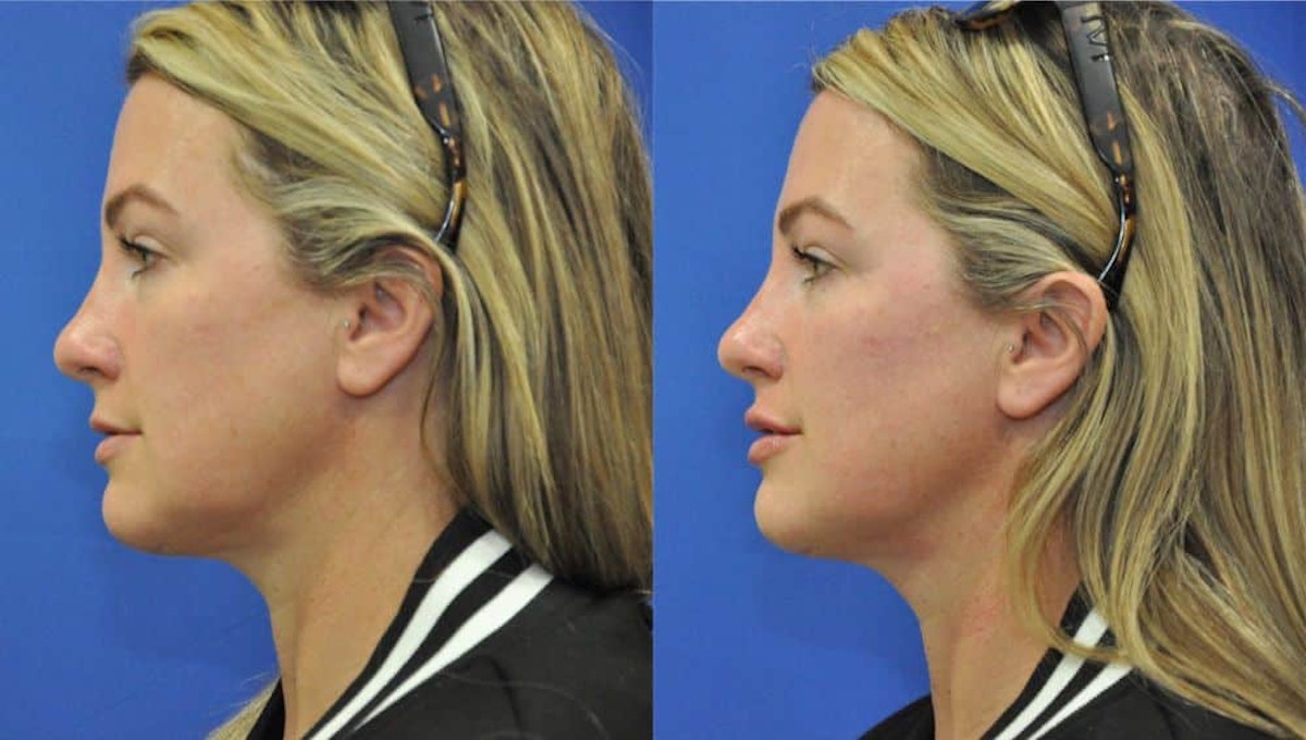 Lip Augmentation Before & After Gallery - Patient 245609 - Image 4