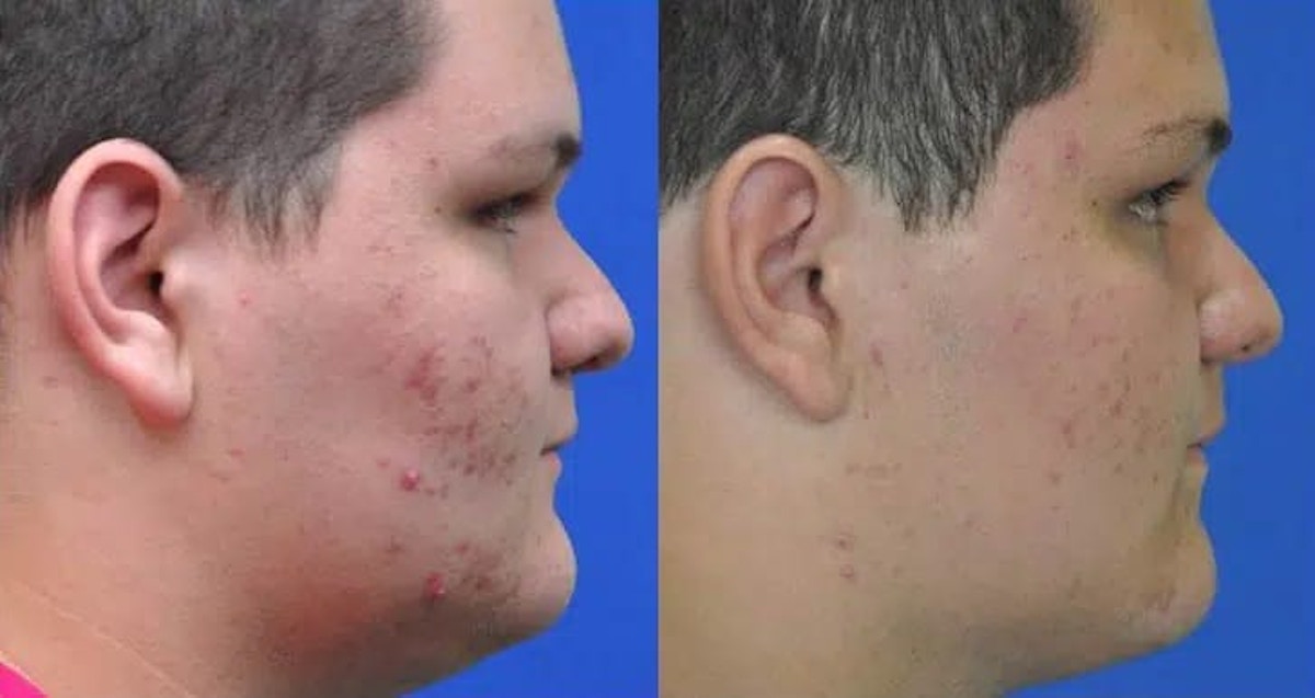 Acne Treatment Before & After Gallery - Patient 242806 - Image 2