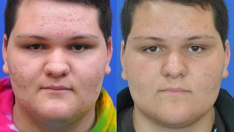 Acne Treatment Before & After Gallery - Patient 242806 - Image 1