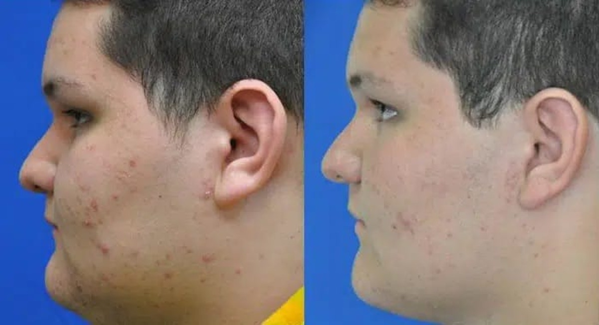 Acne Treatment Before & After Gallery - Patient 242806 - Image 3