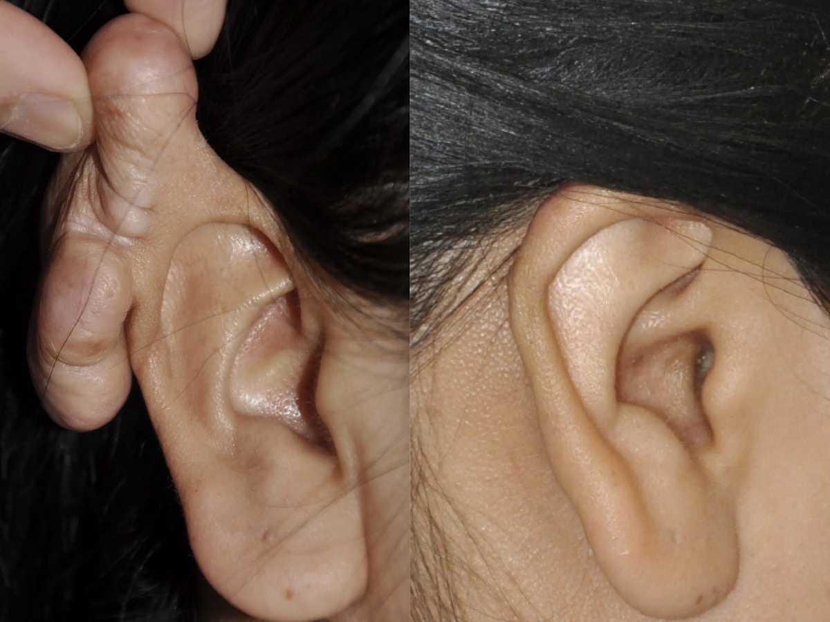 Ear Keloid Surgery Before & After Gallery - Patient 164217 - Image 1