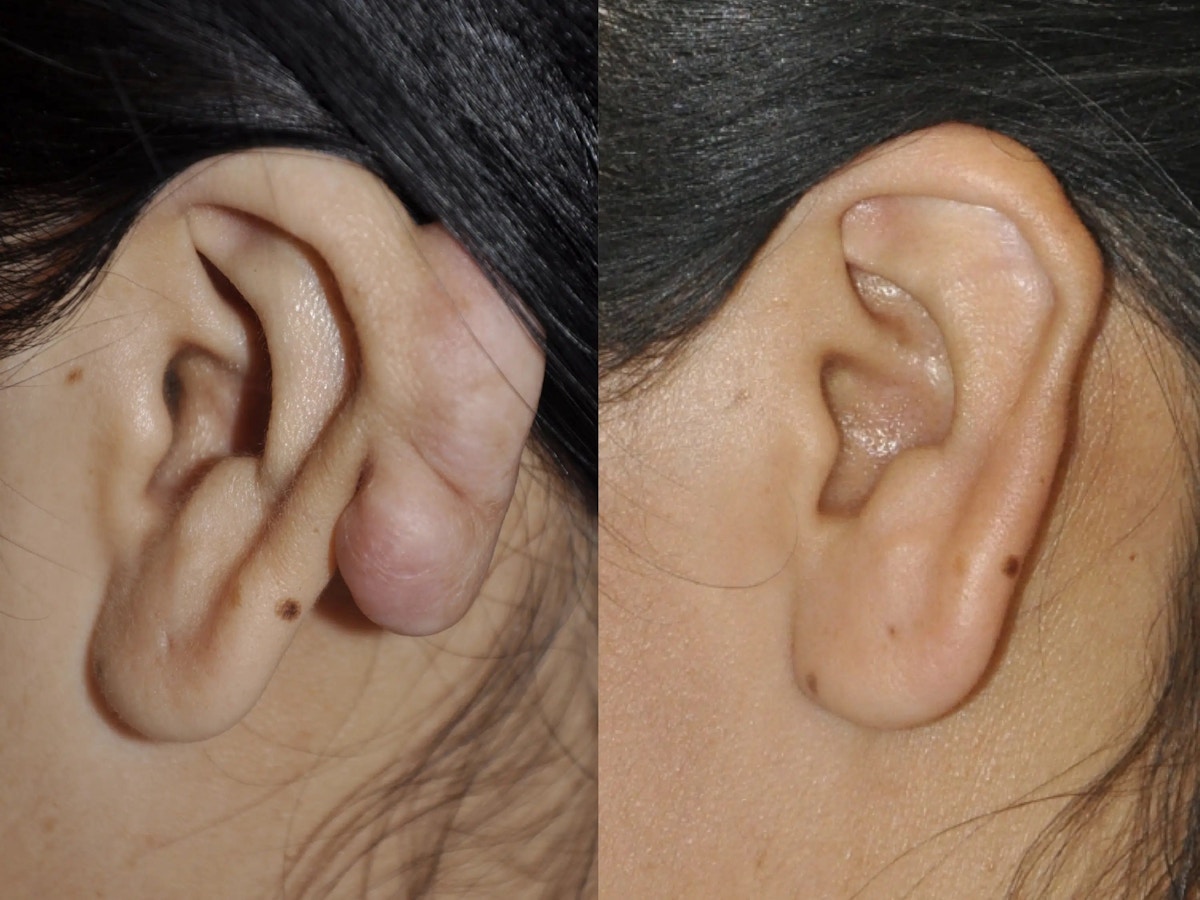 Ear Keloid Surgery Before & After Gallery - Patient 164217 - Image 2