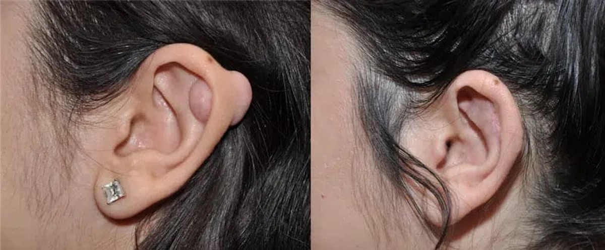 Ear Keloid Surgery Before & After Gallery - Patient 424731 - Image 1