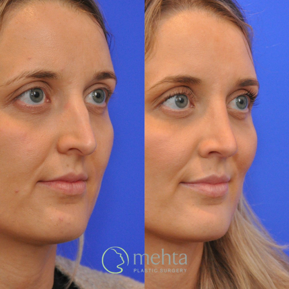 Rhinoplasty Before & After Gallery - Patient 265167 - Image 6