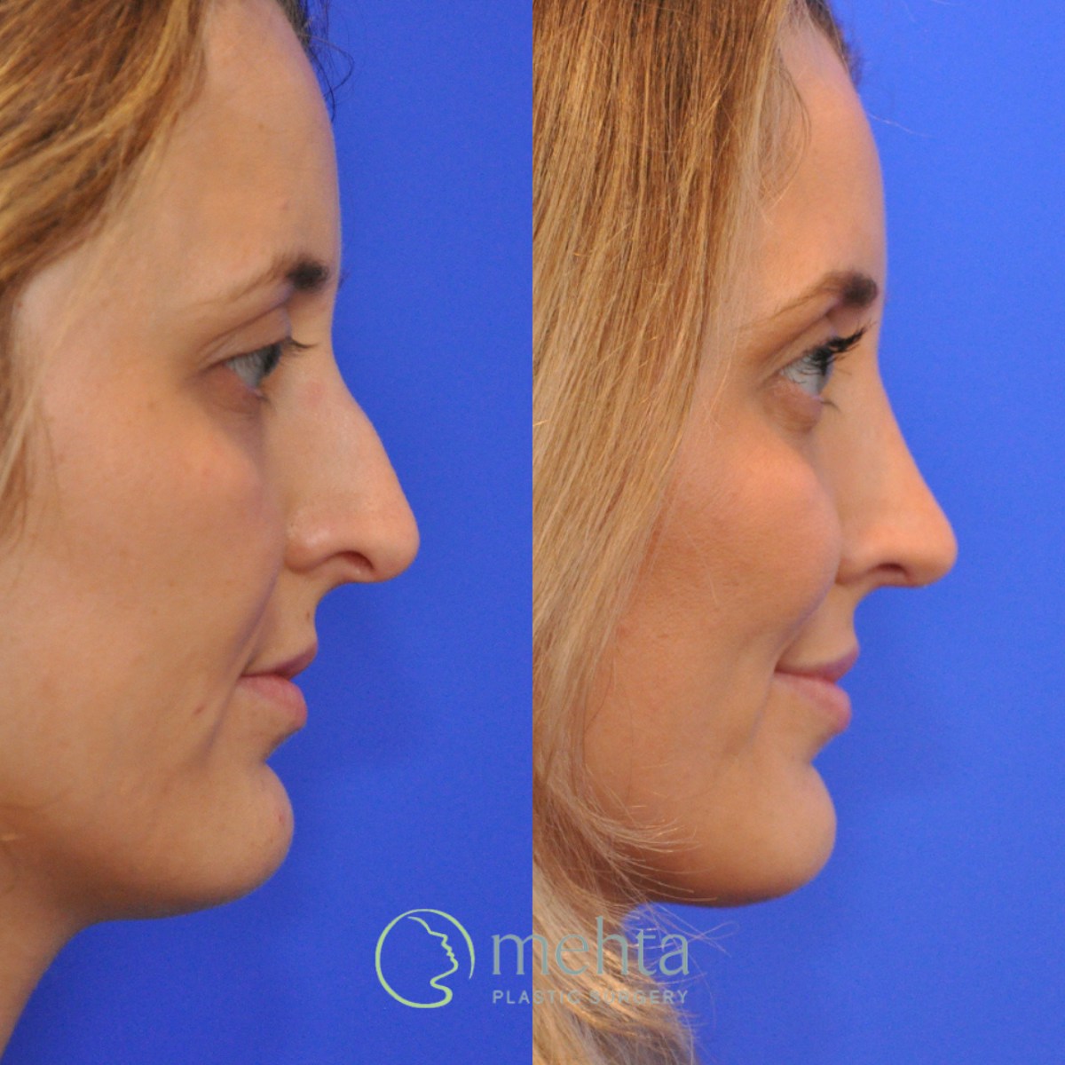 Rhinoplasty Before & After Gallery - Patient 265167 - Image 5