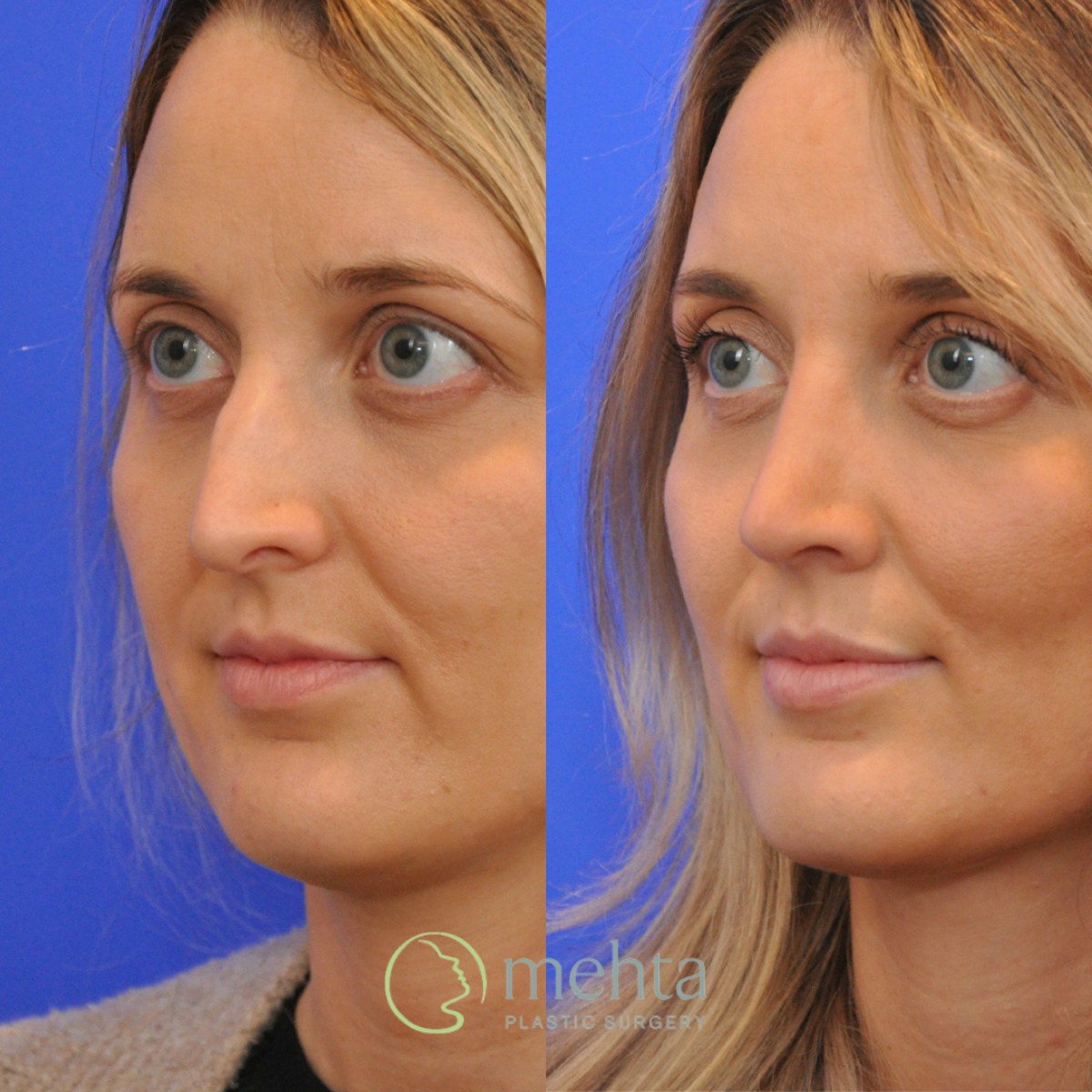 Rhinoplasty Before & After Gallery - Patient 265167 - Image 2
