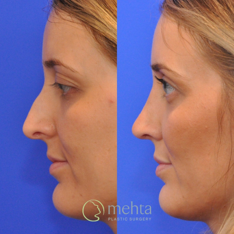 Rhinoplasty Before & After Gallery - Patient 265167 - Image 1