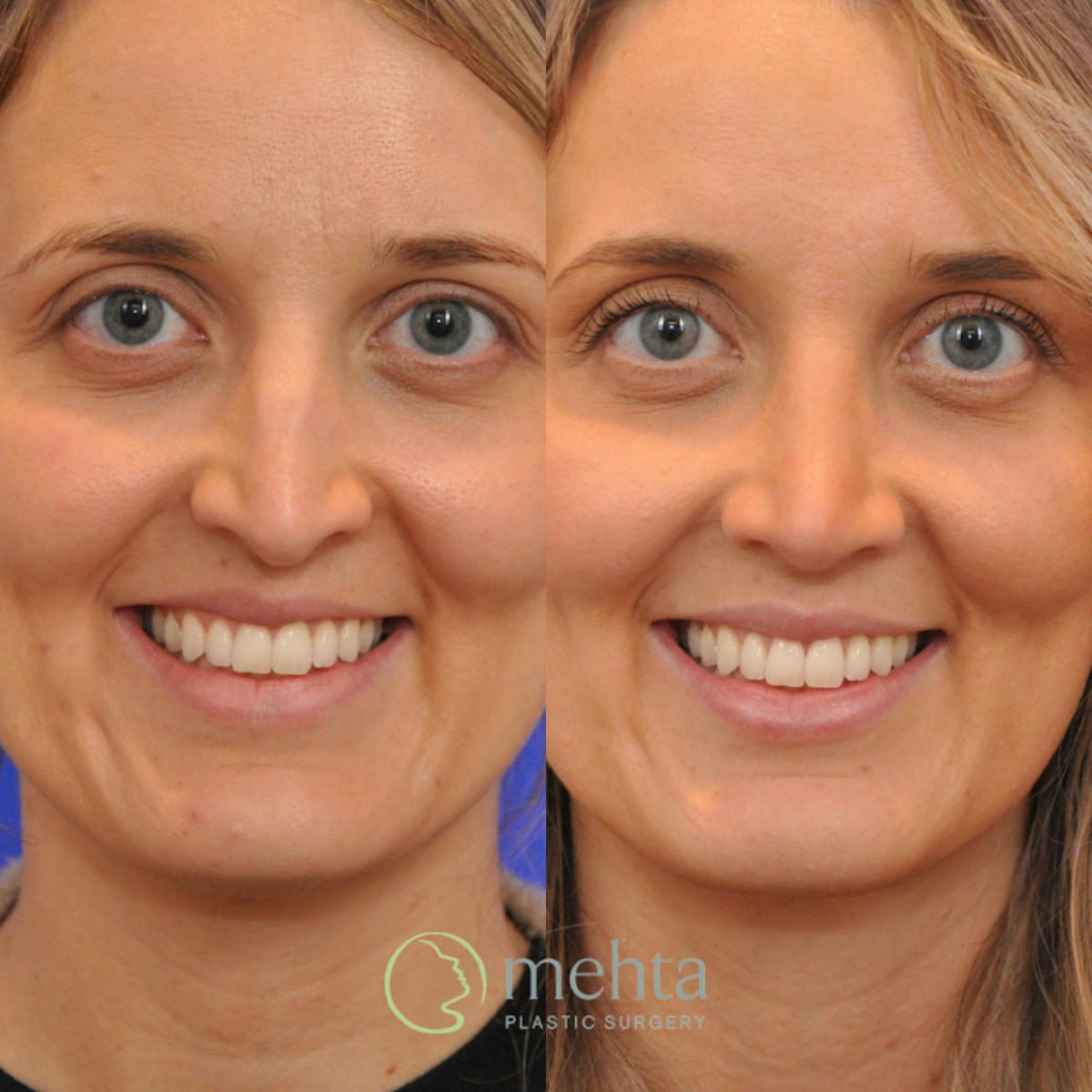 Rhinoplasty Before & After Gallery - Patient 265167 - Image 4