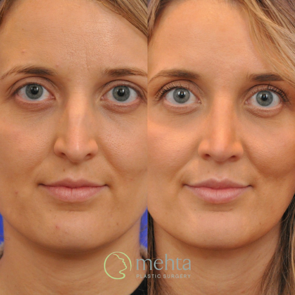 Rhinoplasty Before & After Gallery - Patient 265167 - Image 3