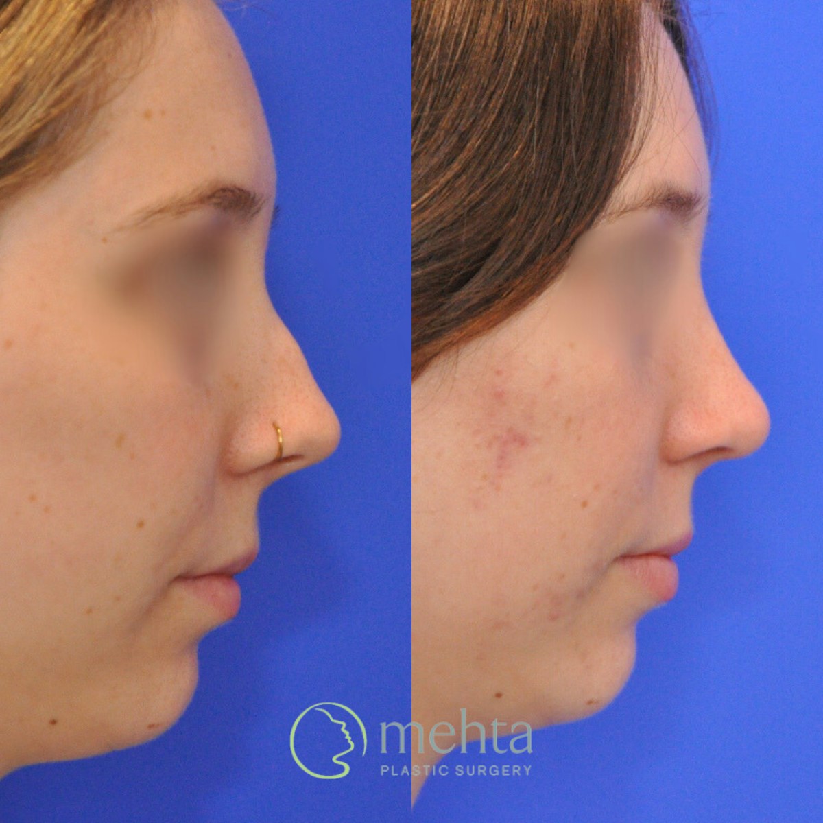 Rhinoplasty Before & After Gallery - Patient 246986 - Image 5