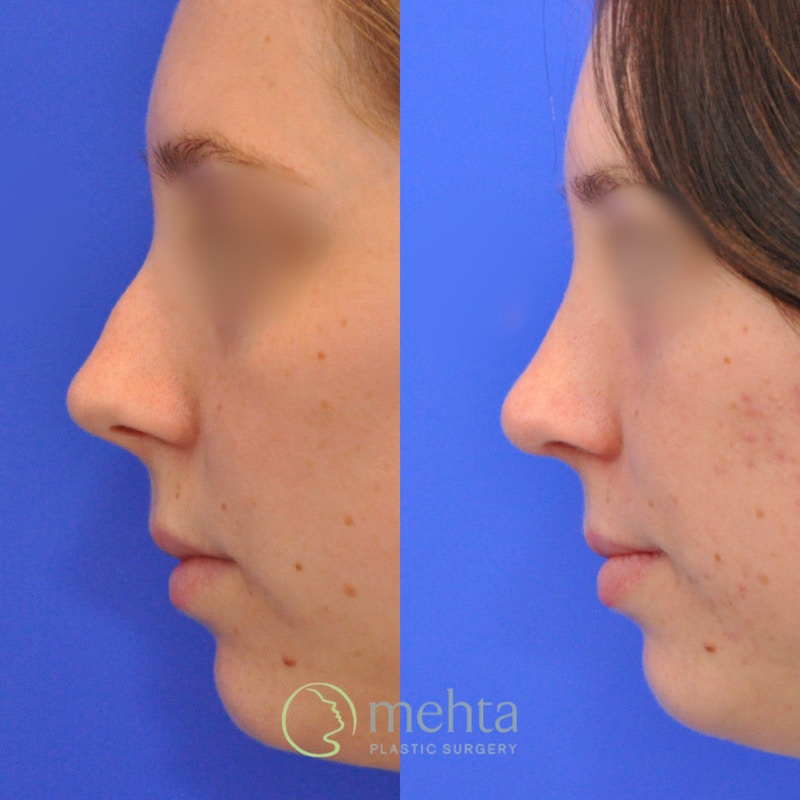 Rhinoplasty Before & After Gallery - Patient 246986 - Image 1