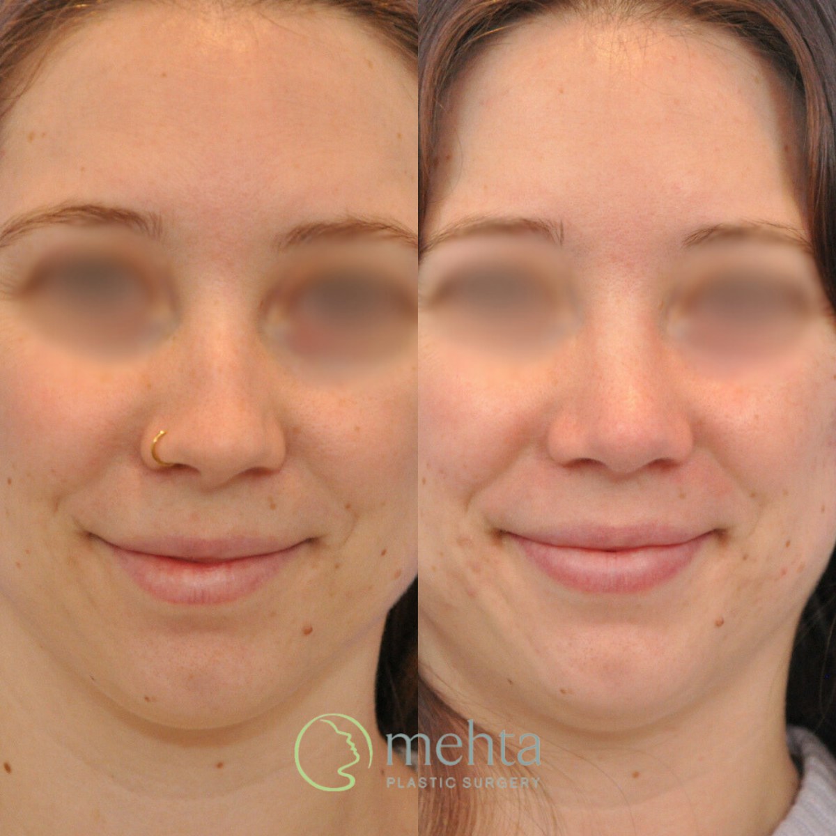 Rhinoplasty Before & After Gallery - Patient 246986 - Image 4