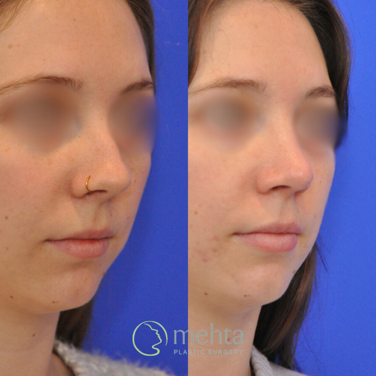 Rhinoplasty Before & After Gallery - Patient 246986 - Image 6