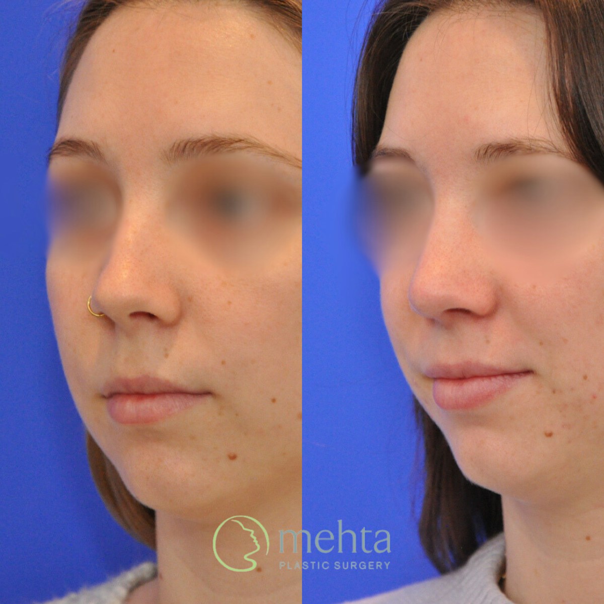 Rhinoplasty Before & After Gallery - Patient 246986 - Image 2
