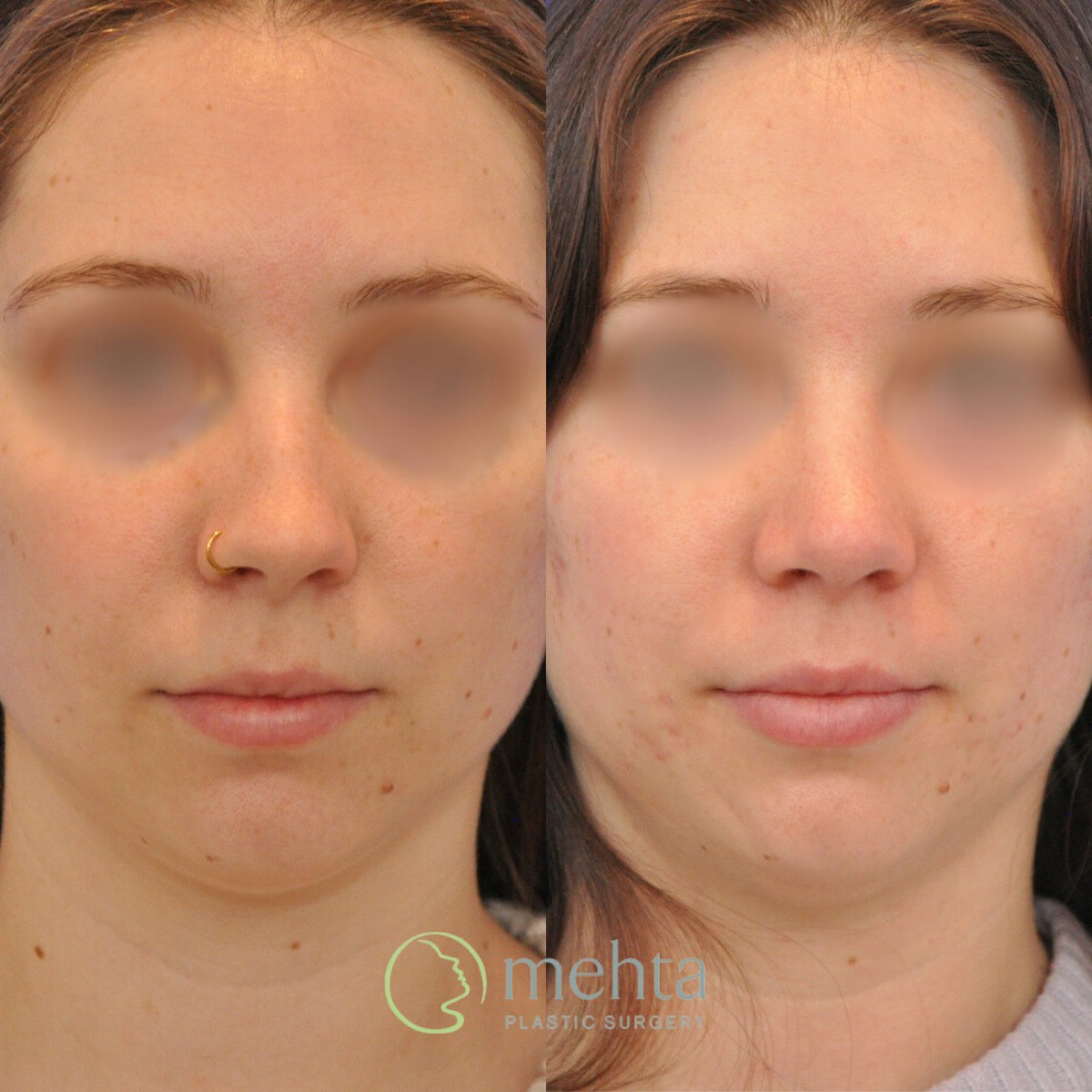 Rhinoplasty Before & After Gallery - Patient 246986 - Image 3