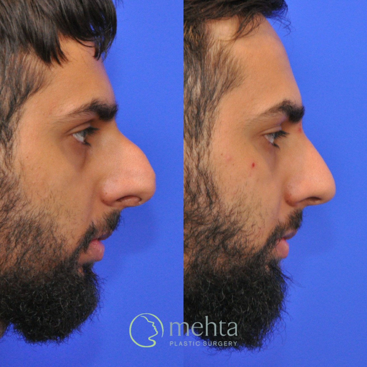 Rhinoplasty Before & After Gallery - Patient 245796 - Image 4