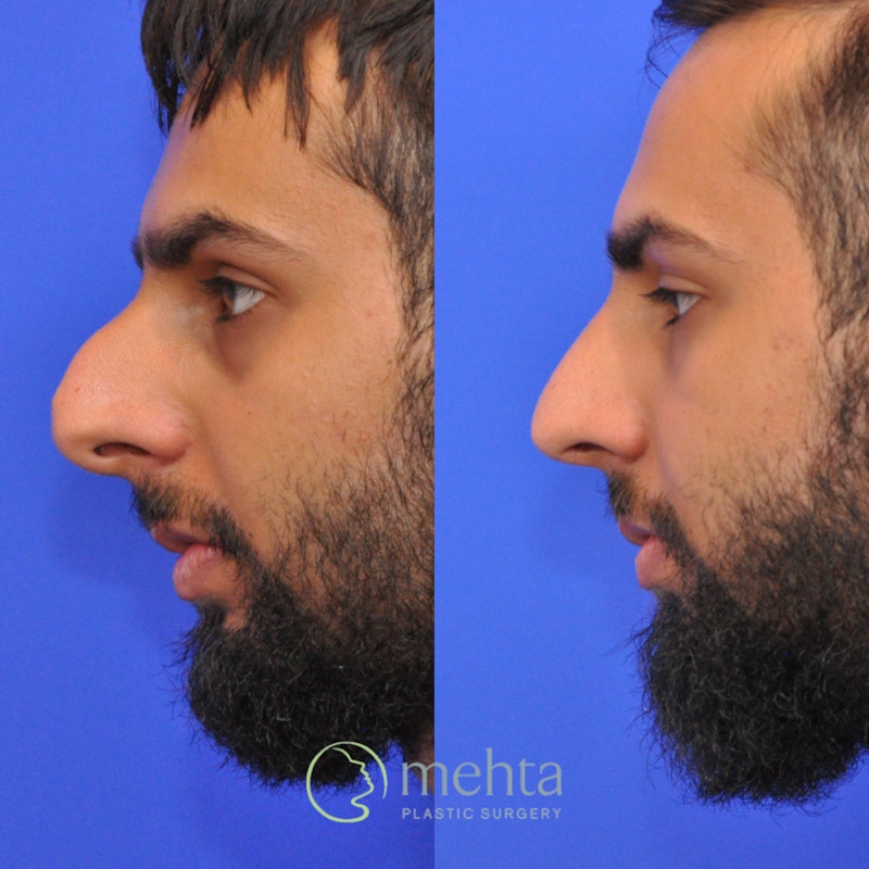 Rhinoplasty Before & After Gallery - Patient 245796 - Image 1