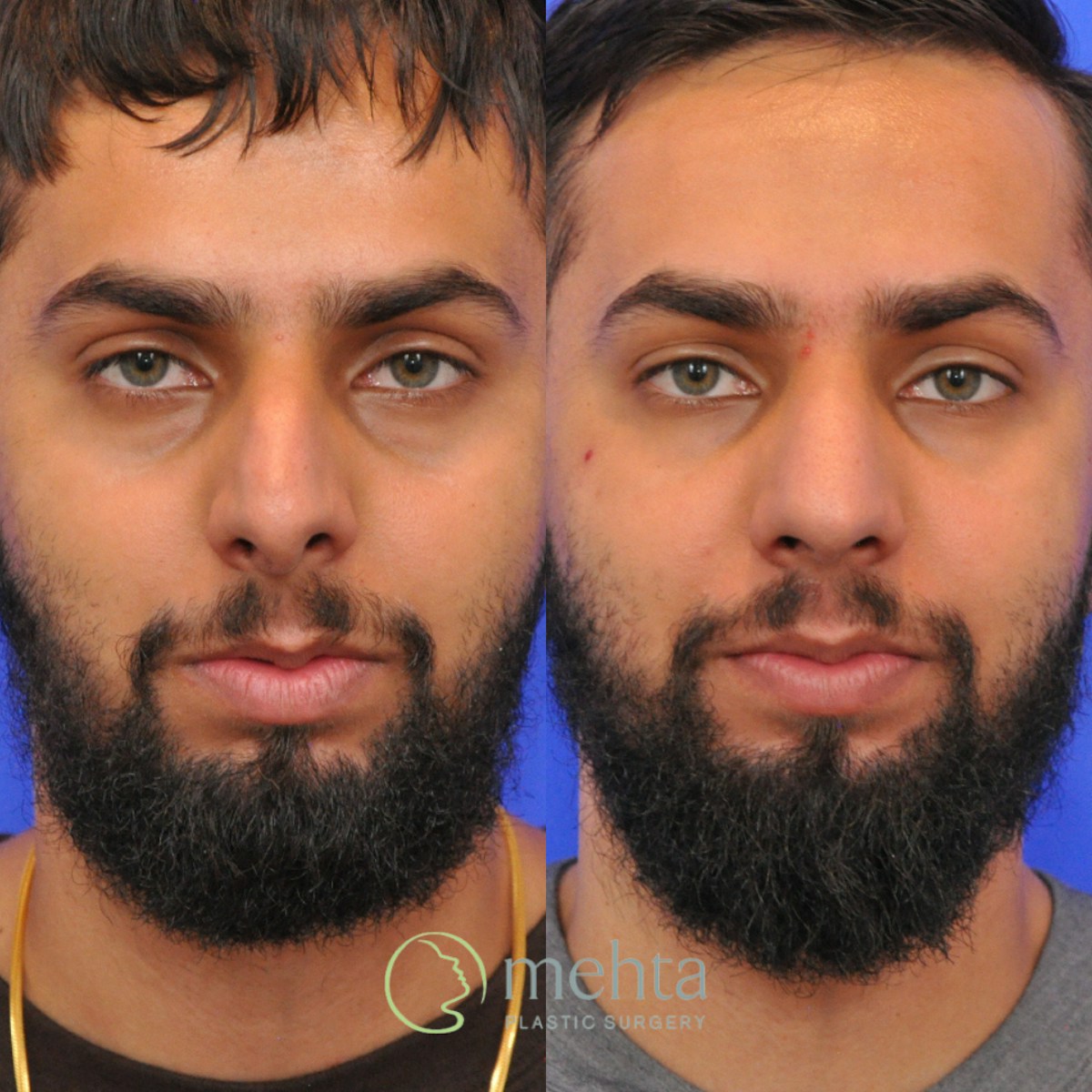 Rhinoplasty Before & After Gallery - Patient 245796 - Image 3