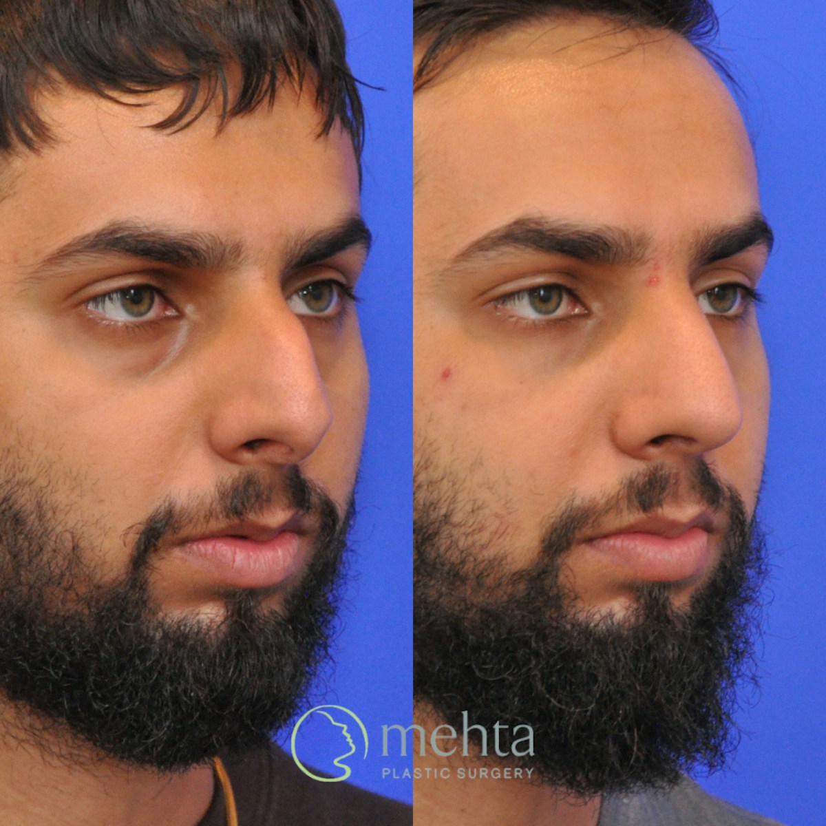 Rhinoplasty Before & After Gallery - Patient 245796 - Image 5