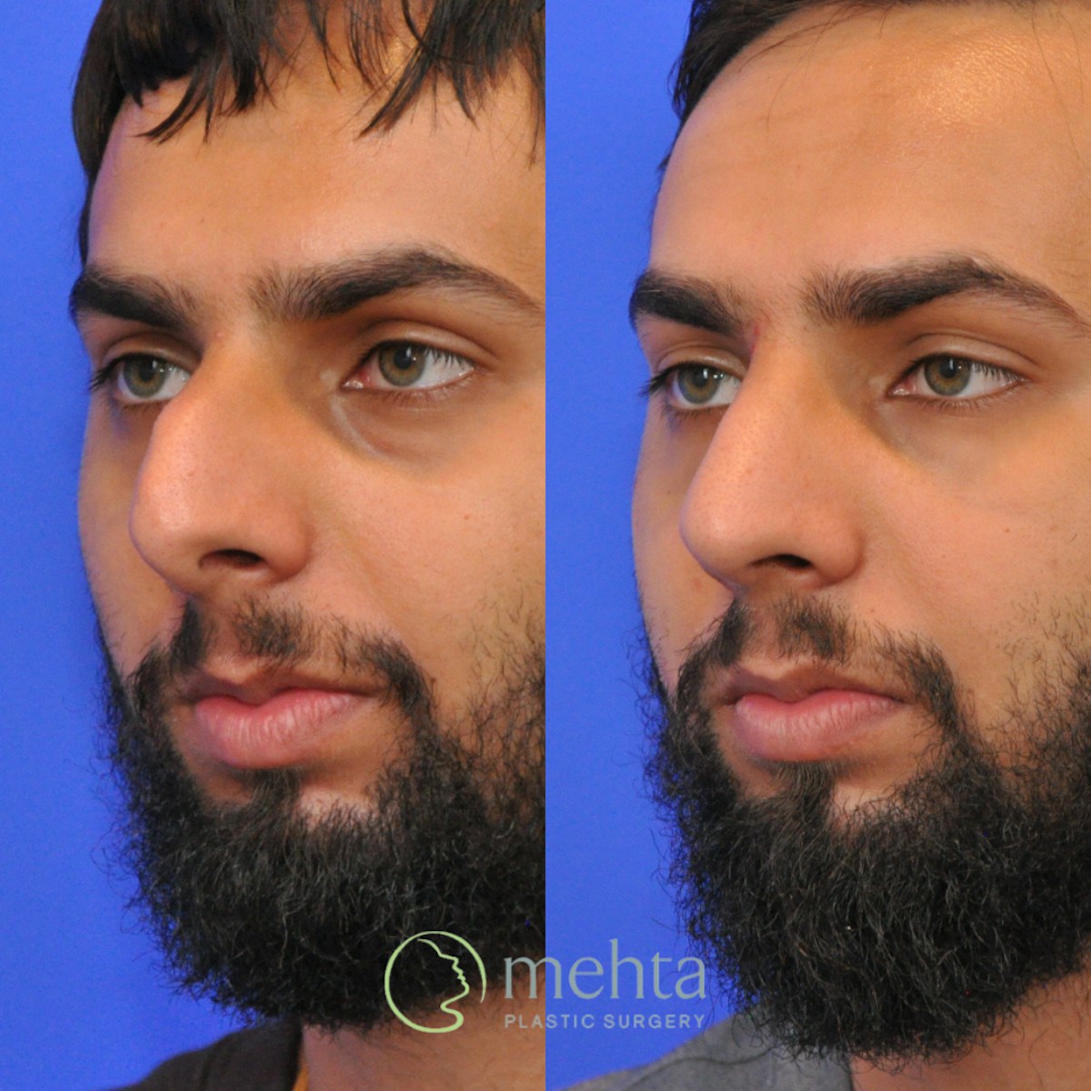 Rhinoplasty Before & After Gallery - Patient 245796 - Image 2