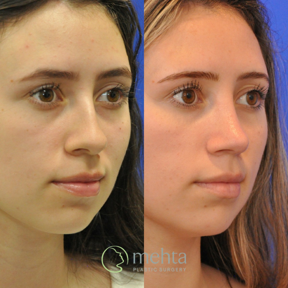 Rhinoplasty Before & After Gallery - Patient 256234 - Image 3