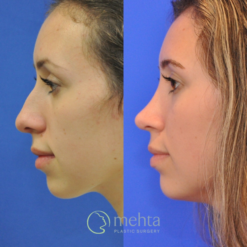 Rhinoplasty Before & After Gallery - Patient 256234 - Image 1