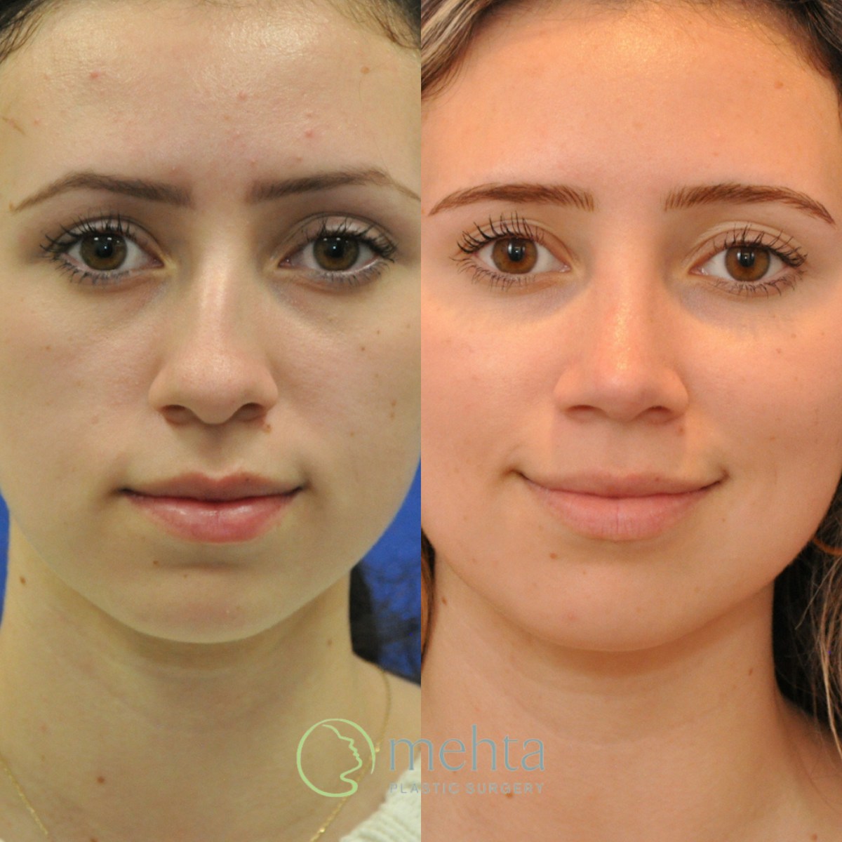 Rhinoplasty Before & After Gallery - Patient 256234 - Image 2