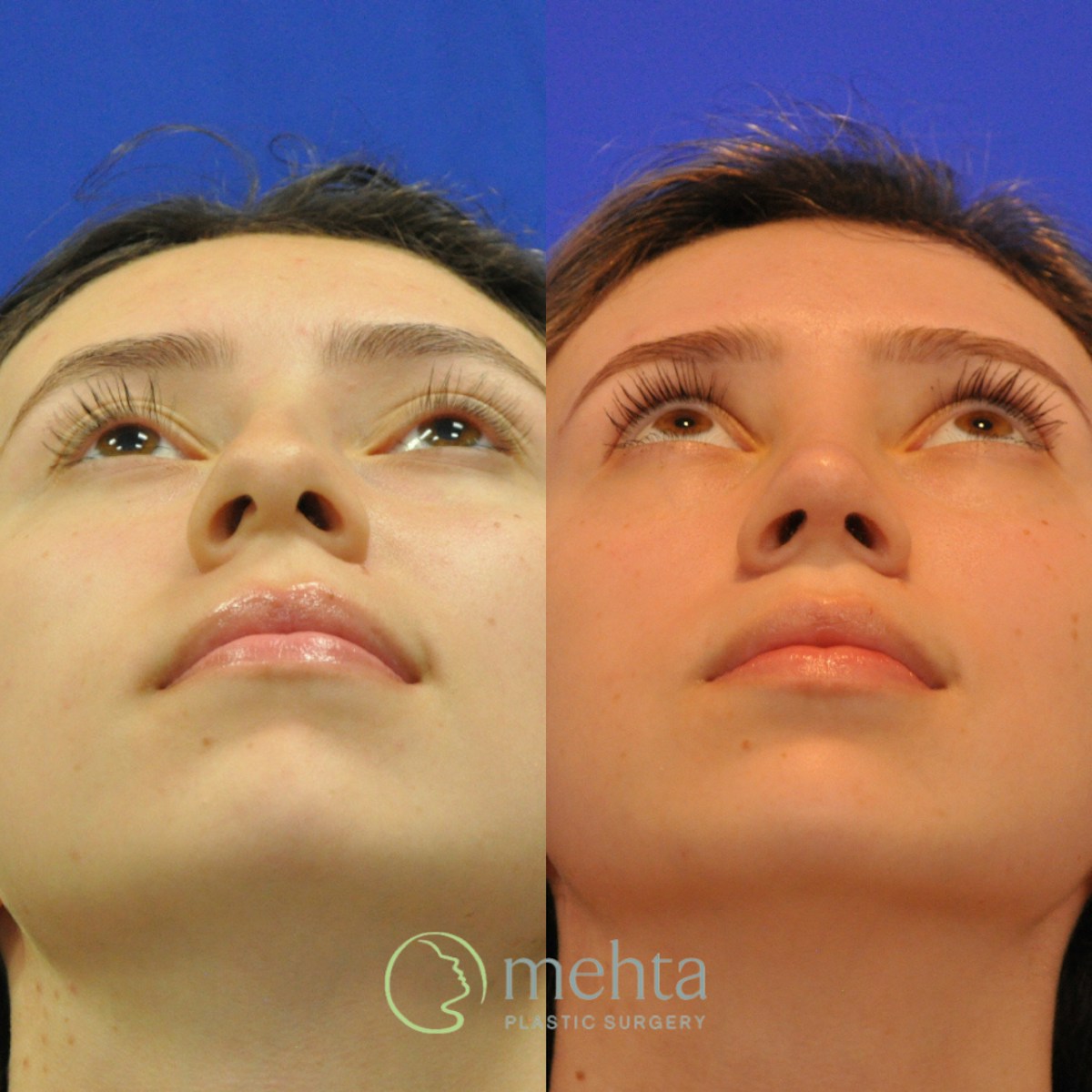 Rhinoplasty Before & After Gallery - Patient 256234 - Image 4