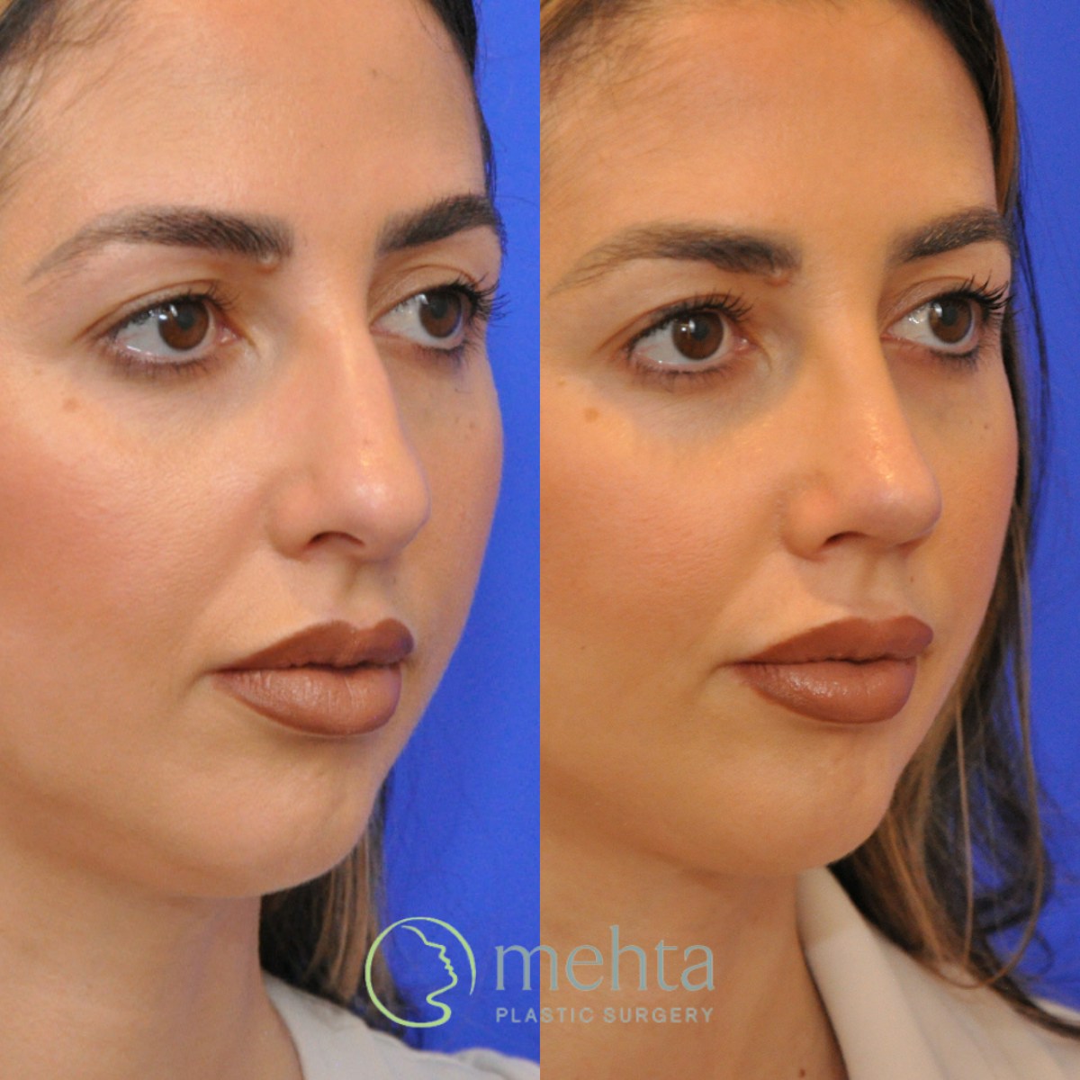 Rhinoplasty Before & After Gallery - Patient 370957 - Image 6