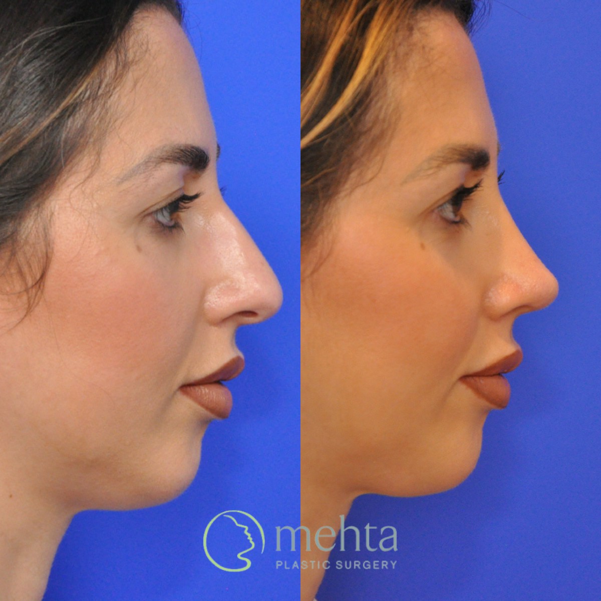 Rhinoplasty Before & After Gallery - Patient 370957 - Image 5