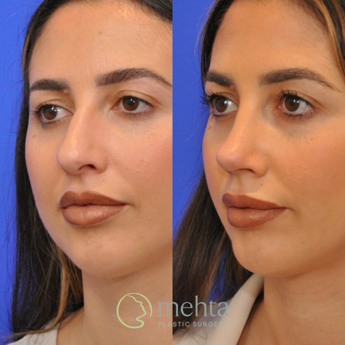 Rhinoplasty Before & After Gallery - Patient 370957 - Image 2