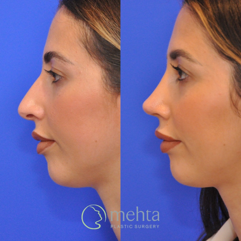 Rhinoplasty Before & After Gallery - Patient 370957 - Image 1