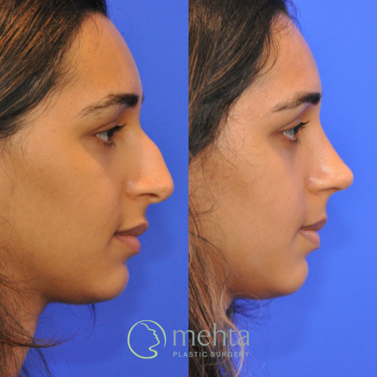 Rhinoplasty Before & After Gallery - Patient 343019 - Image 5