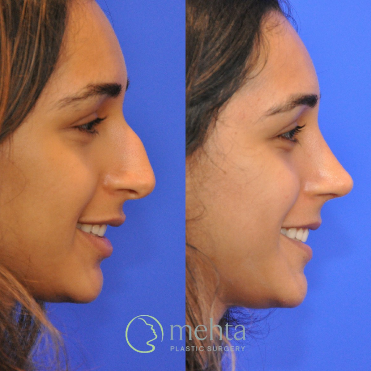 Rhinoplasty Before & After Gallery - Patient 343019 - Image 6