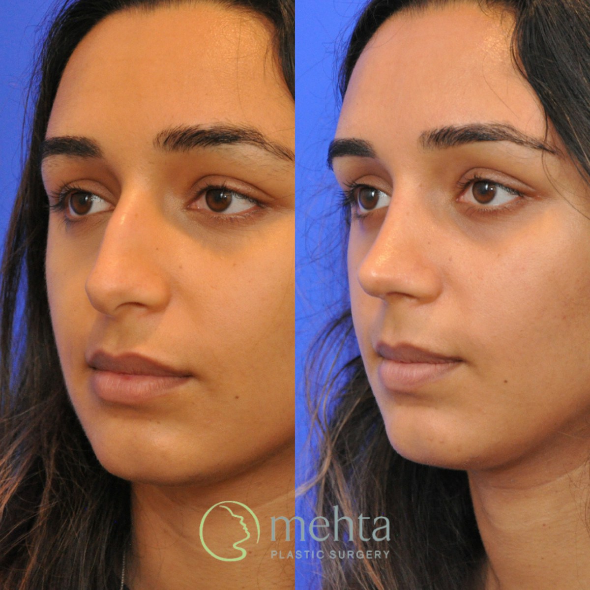 Rhinoplasty Before & After Gallery - Patient 343019 - Image 2