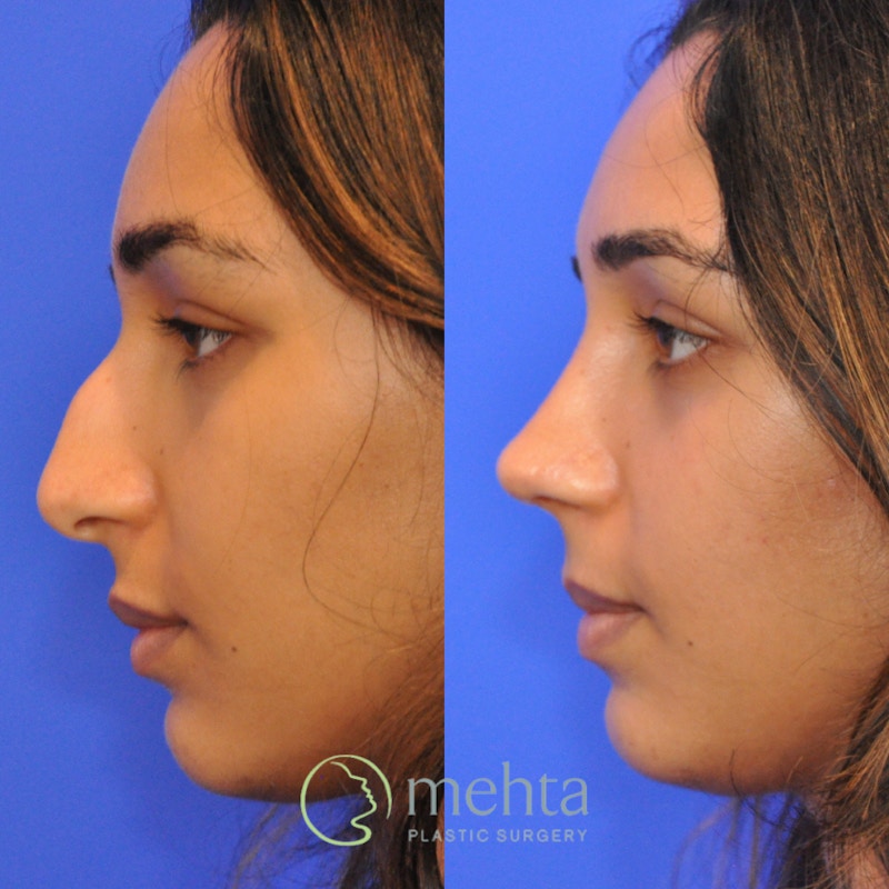 Rhinoplasty Before & After Gallery - Patient 343019 - Image 1