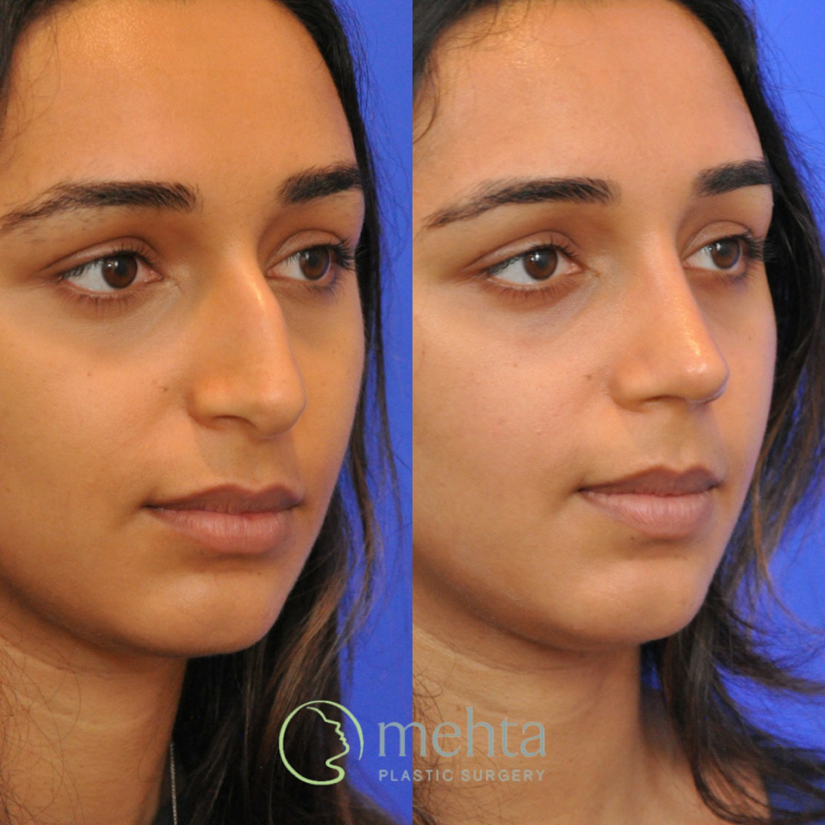 Rhinoplasty Before & After Gallery - Patient 343019 - Image 4