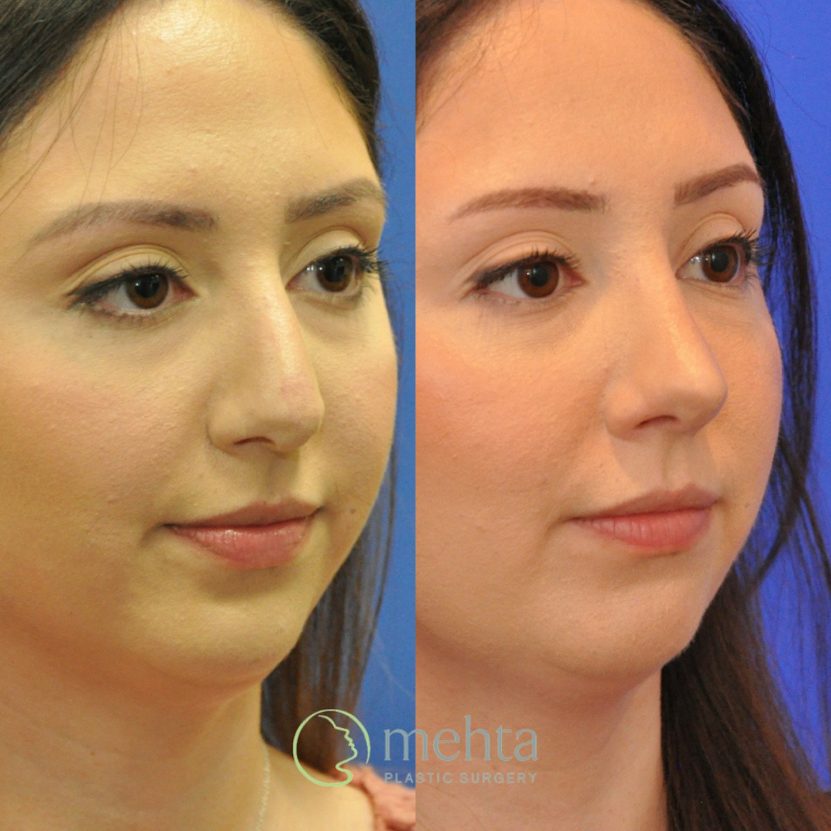 Rhinoplasty Before & After Gallery - Patient 236652 - Image 3