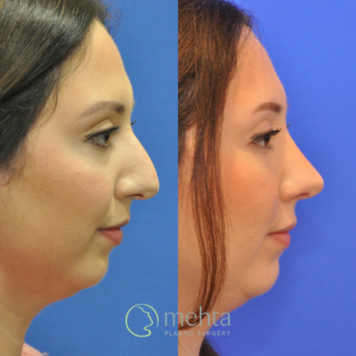 Rhinoplasty Before & After Gallery - Patient 236652 - Image 2