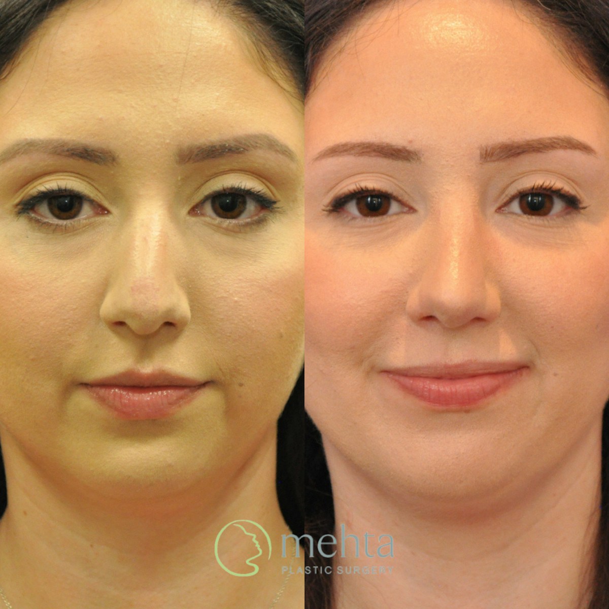 Rhinoplasty Before & After Gallery - Patient 236652 - Image 4