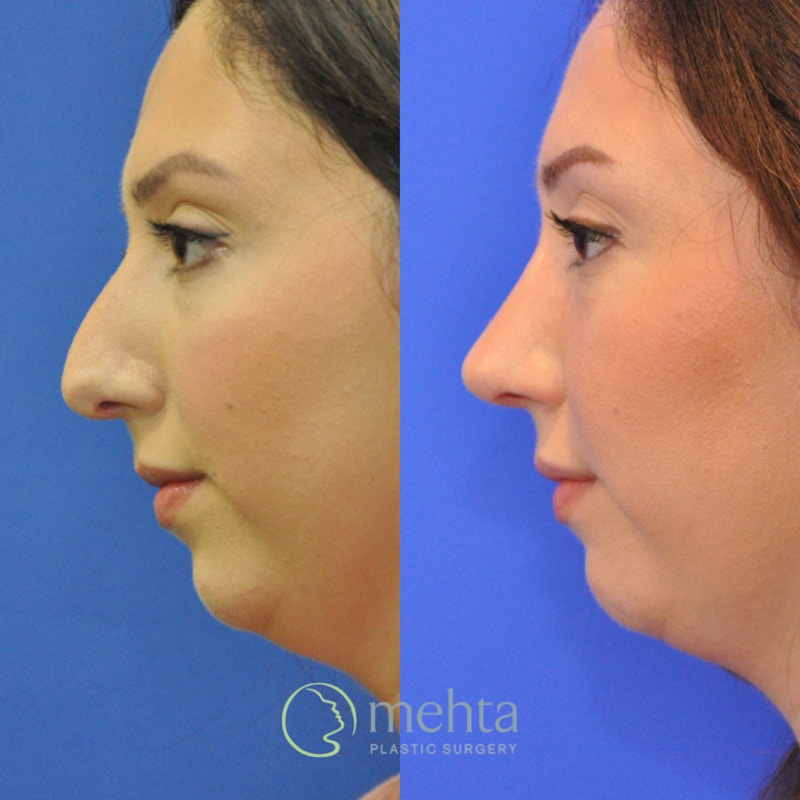 Rhinoplasty Before & After Gallery - Patient 236652 - Image 1