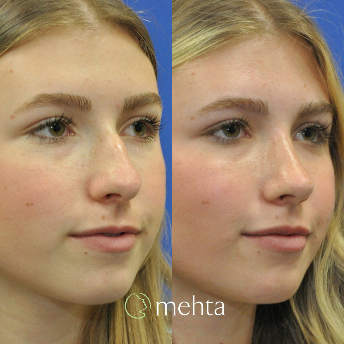 Rhinoplasty Before & After Gallery - Patient 928766 - Image 3