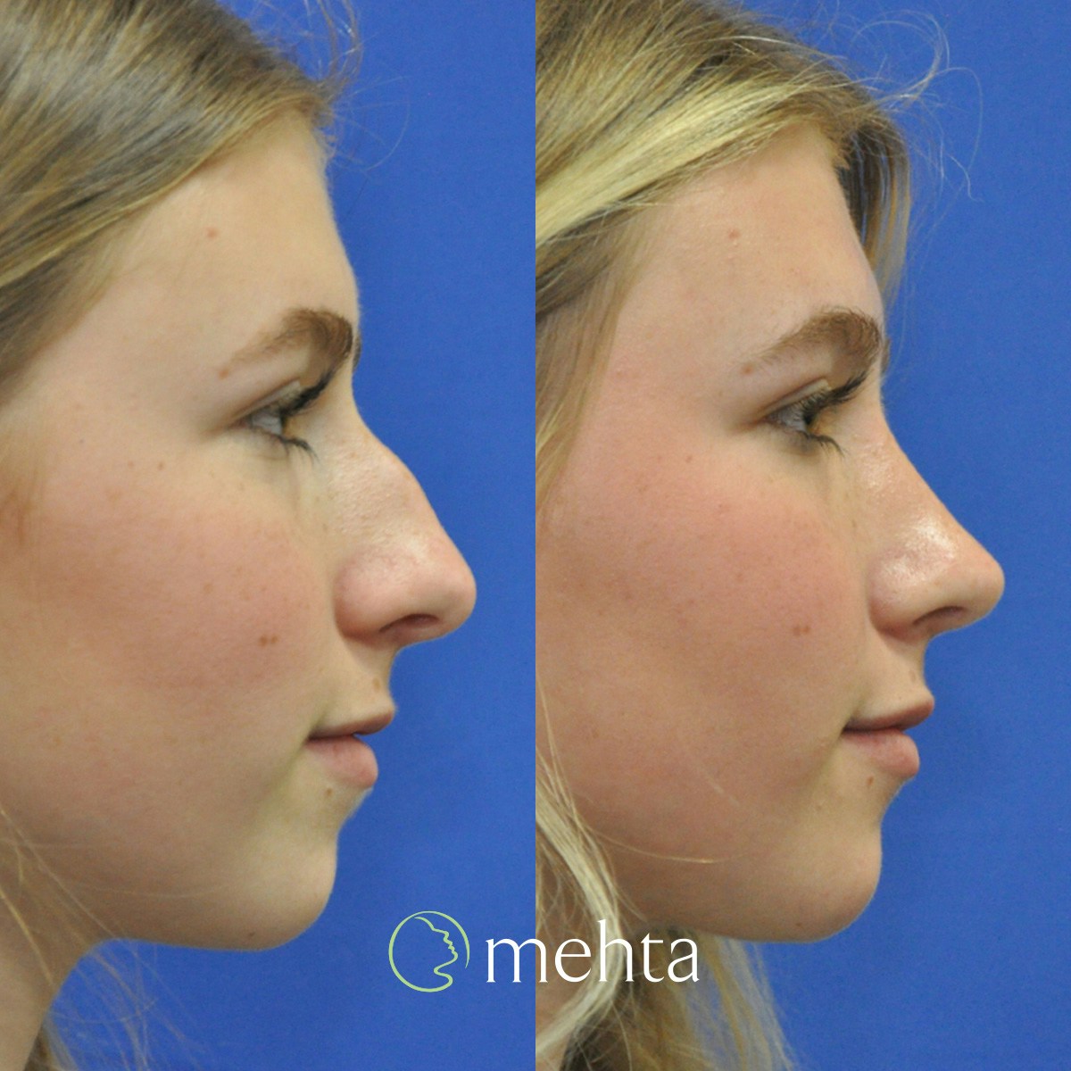 Rhinoplasty Before & After Gallery - Patient 928766 - Image 1