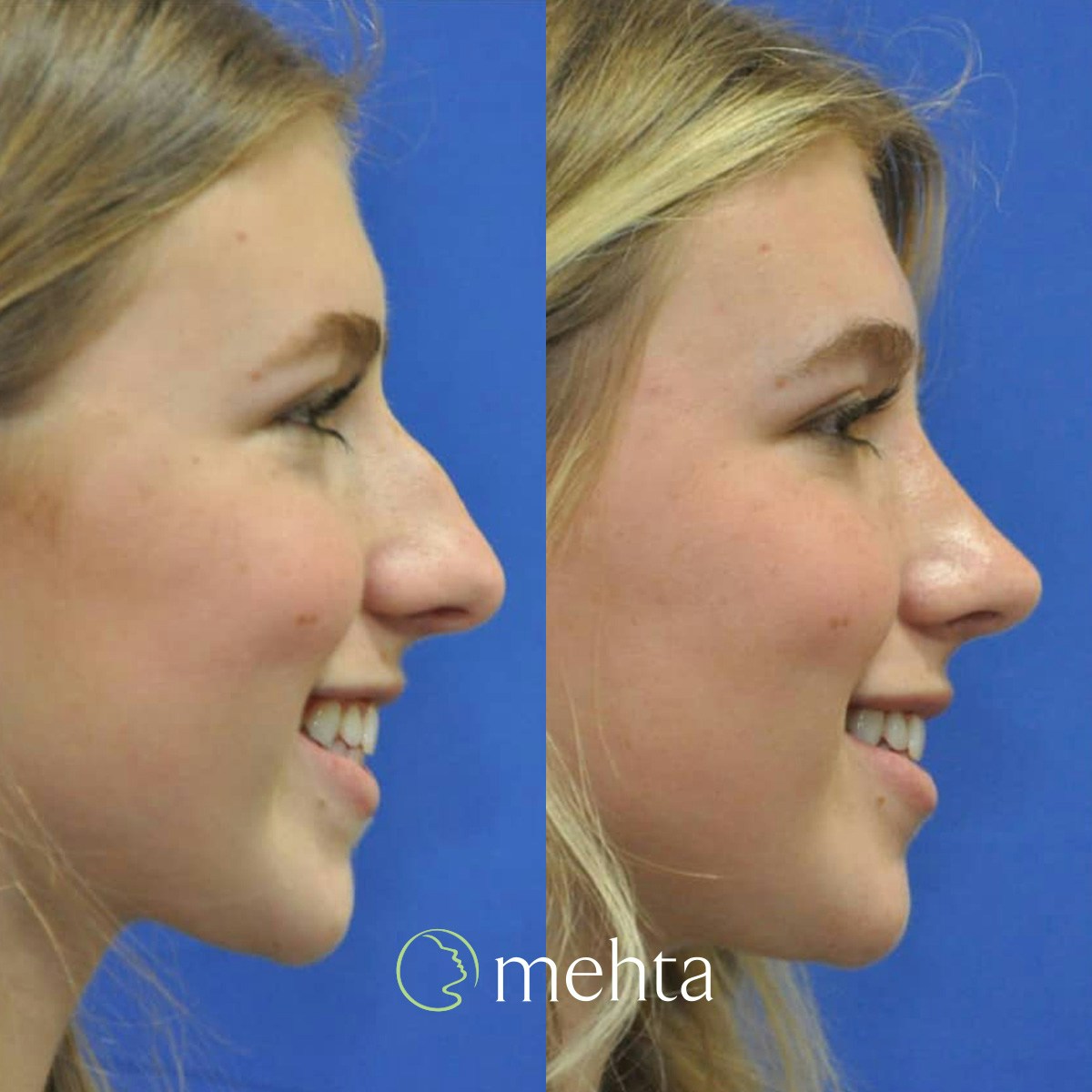 Rhinoplasty Before & After Gallery - Patient 928766 - Image 2