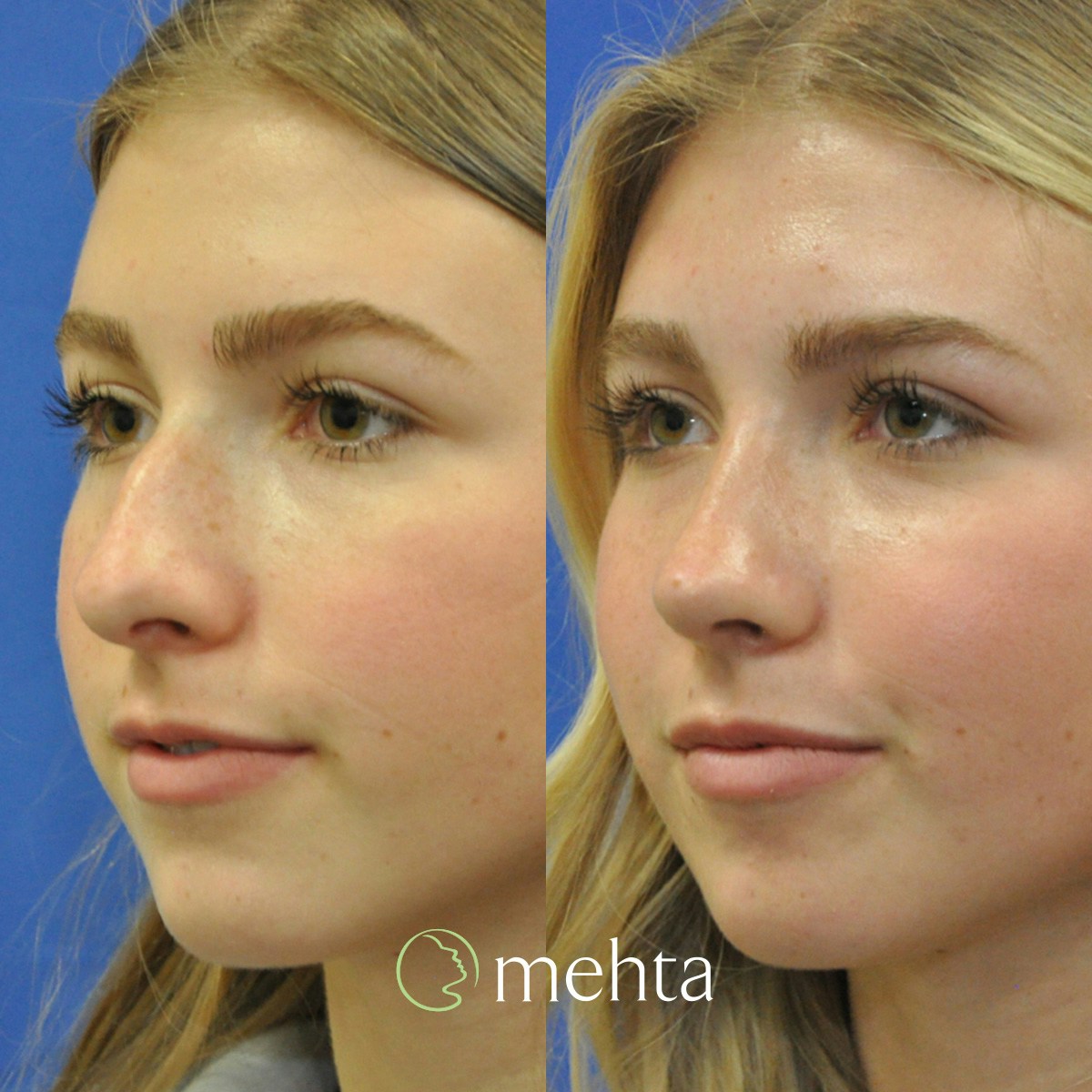Rhinoplasty Before & After Gallery - Patient 928766 - Image 5