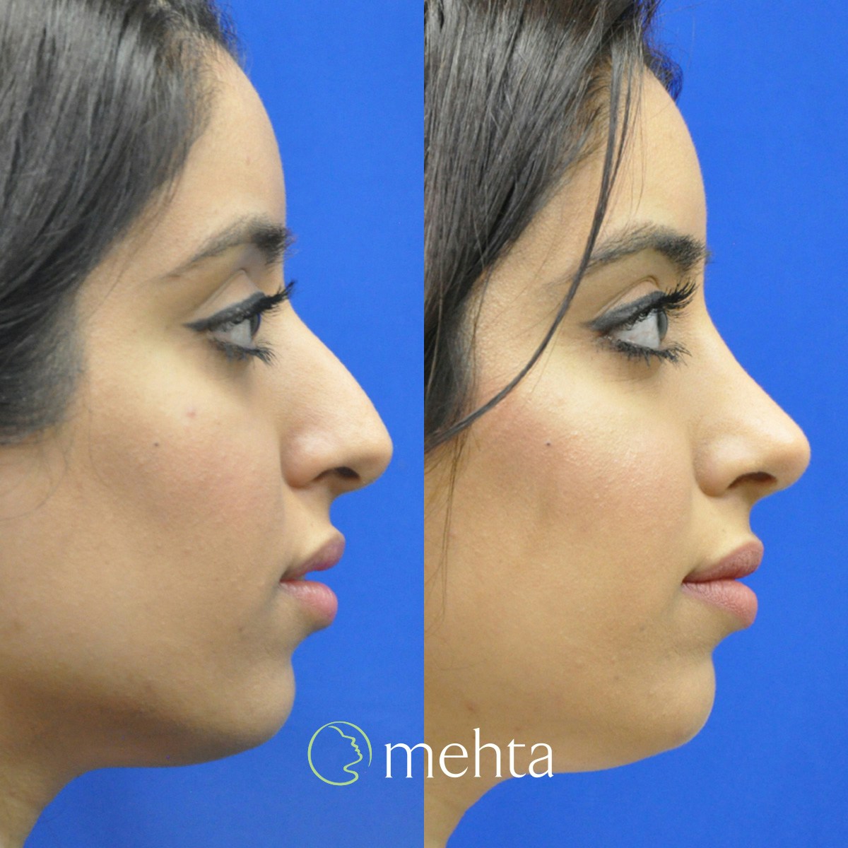 Rhinoplasty Before & After Gallery - Patient 750335 - Image 5